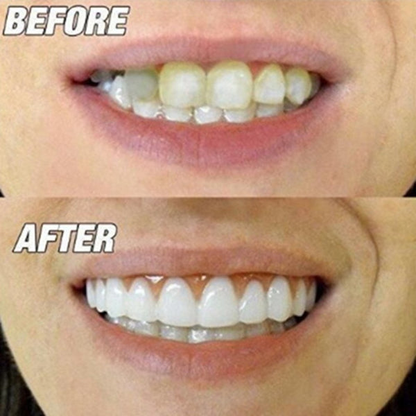 Cosmetic Veneer Upper Tooth Concealer